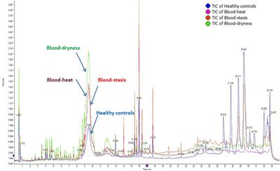 Metabonomics Study on Serum Characteristic Metabolites of Psoriasis Vulgaris Patients With Blood-Stasis Syndrome